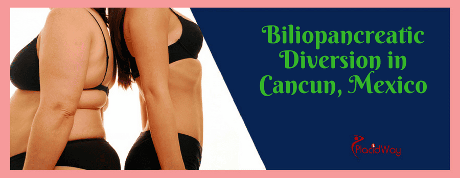 Biliopancreatic Diversion in Cancun Mexico